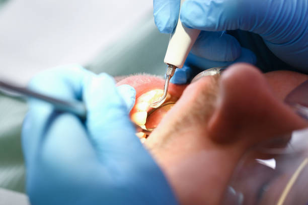 Best Emergency Treatment for Dental Infections or Abscesses in Augusta, GA