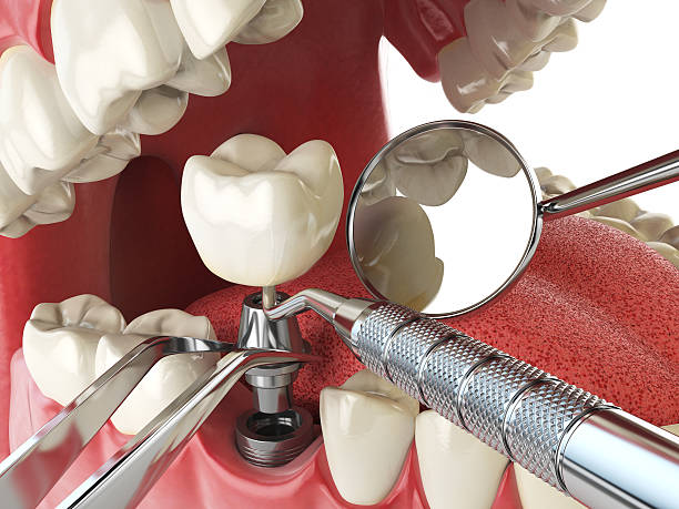 Best Emergency Wisdom Teeth Removal in Augusta, GA